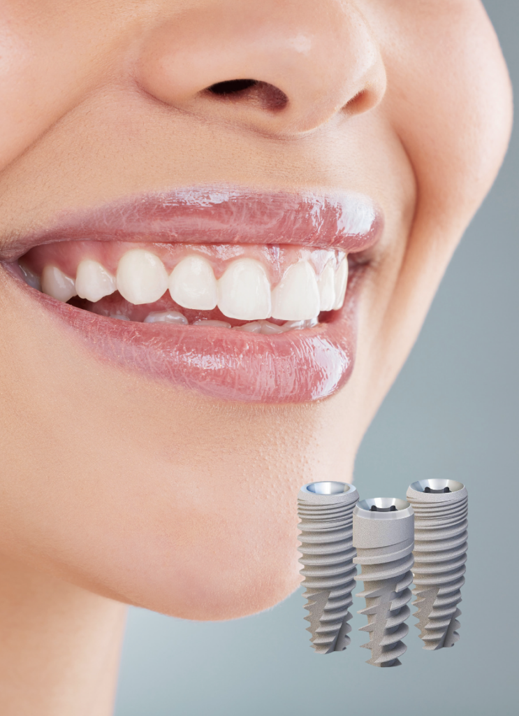 Implantes dentários Paltop Keystone